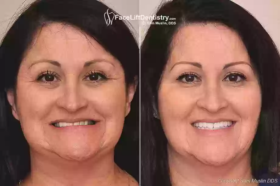 Face Lift Dentistry before after